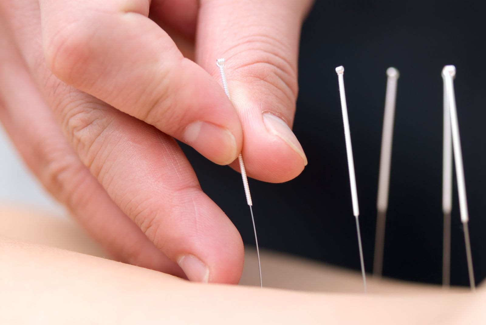 How Acupuncture & Herbs Treat PMS Community Acupuncture Clinic